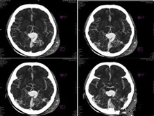 大脑大静脉瘤