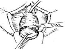 阴道斜隔