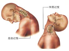 颈部扭伤