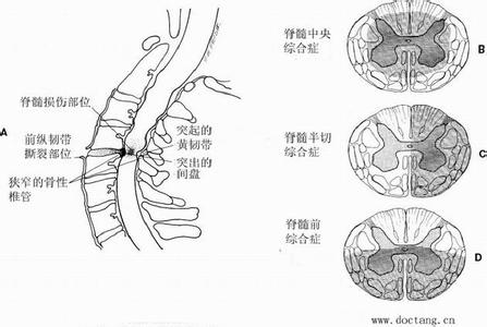 颈部脊髓损伤
