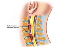 颈部韧带扭伤