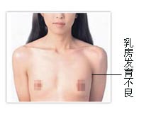 乳房发育不良