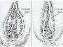 多毛状小阴唇