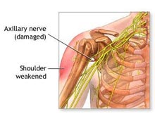 肩神经损伤