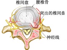 腰椎间盘突出