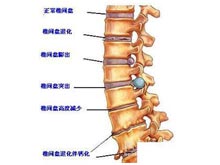 腰椎间盘变性