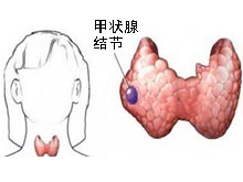 甲状腺结节