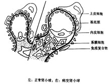 系膜毛细血管性肾小球肾炎