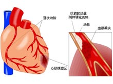 陈旧性心肌梗死