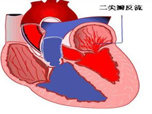 二尖瓣环钙化