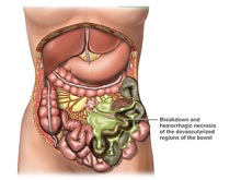 肠坏死