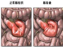 肠套叠