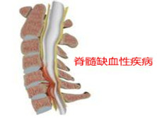 脊髓缺血性疾病