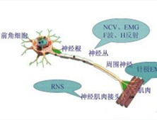 肌萎缩性侧索硬化症