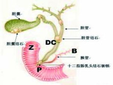 急性梗阻性化脓性胆管炎