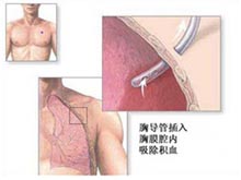 创伤性气胸