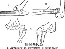 肘关节脱位