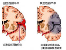 缺血性脑卒中