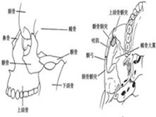 颧骨颧弓骨折