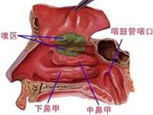 上颌窦恶性肿瘤