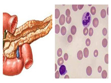 儿童胰腺功能不全并中性粒细胞减少症综合征