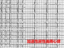 加速性房性逸搏心律