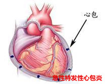 急性特发性心包炎