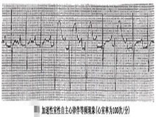 加速性室性自主心律