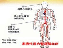 家族性混合型高脂血症