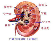 肾石症