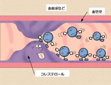 老年高脂血症