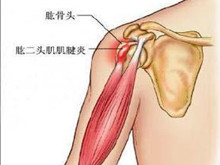 肱二头肌长头腱鞘炎