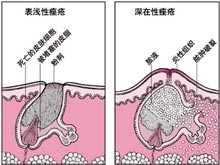 痤疮