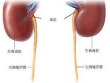 肾盂输尿管连接部梗阻