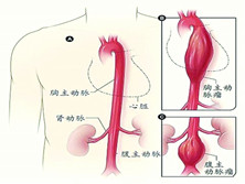 主动脉瘤