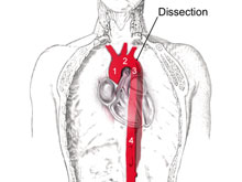 主动脉夹层