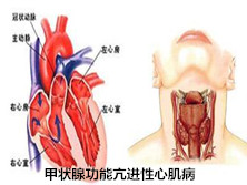 甲状腺功能亢进性心肌病