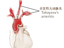 多发性大动脉炎