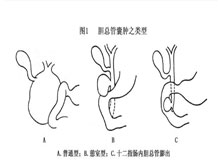 胆总管囊肿