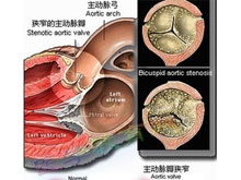 主动脉瓣狭窄