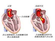 主动脉瓣关闭不全