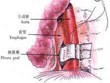 食管克罗恩病