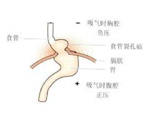 食管裂孔疝