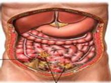 继发性化脓性腹膜炎