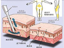 面部吸脂