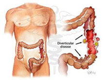 结肠憩室病