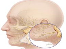 耳源性面瘫