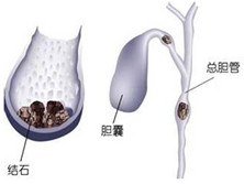 结石性胆囊炎