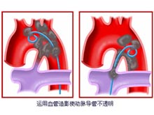 动脉导管未闭