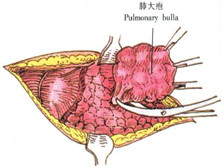 肺大疱